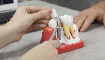 The Complete Guide to Dental Implants: What to Expect at The Art of Smile in Vancouver