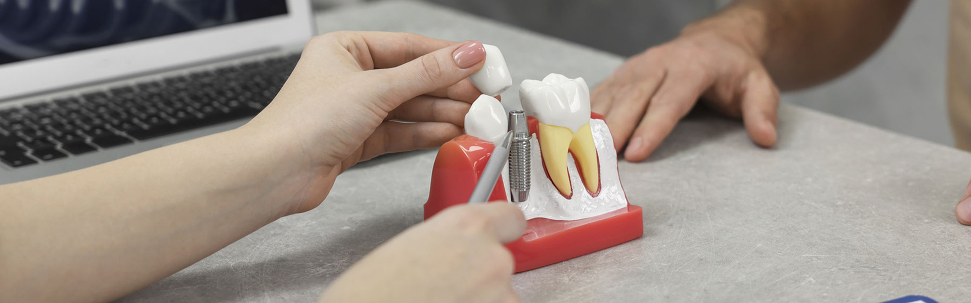 The Complete Guide to Dental Implants: What to Expect at The Art of Smile in Vancouver