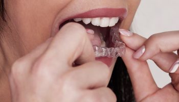 Why Same-Day Night Guards and an In-House Lab Are Game Changers for Your Smile