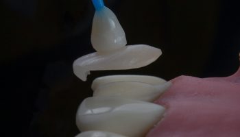 Veneers in Vancouver: Why In-House Dental Labs Are Transforming Smile Design Veneers in Vancouver: Why In-House Dental Labs Are Transforming Smile Design