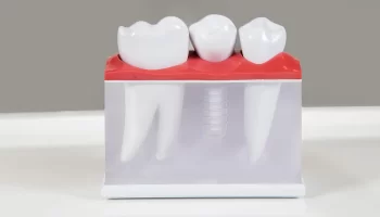 Dental Implants in Downtown Vancouver’s Financial District: A Smart Investment in Your Smile